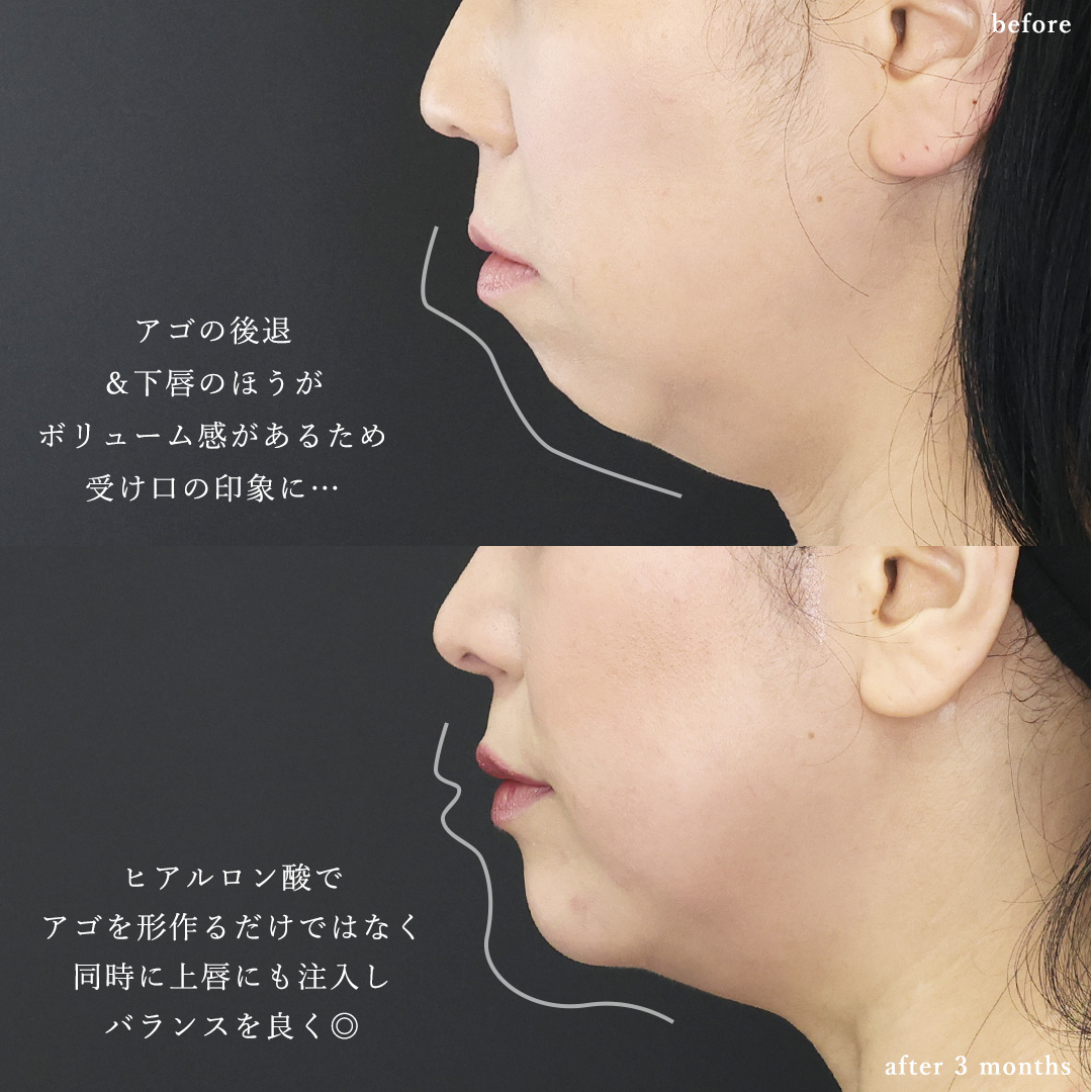 鼻尖形成・鼻尖縮小/鼻先軟骨移植/顎のヒアルロン酸注射の症例写真 施術前後 