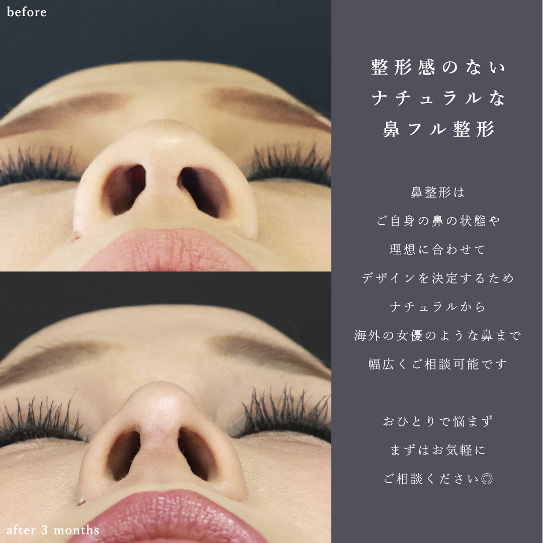 鼻尖形成・鼻尖縮小/鼻先軟骨移植/顎のヒアルロン酸注射の症例写真 施術前後 