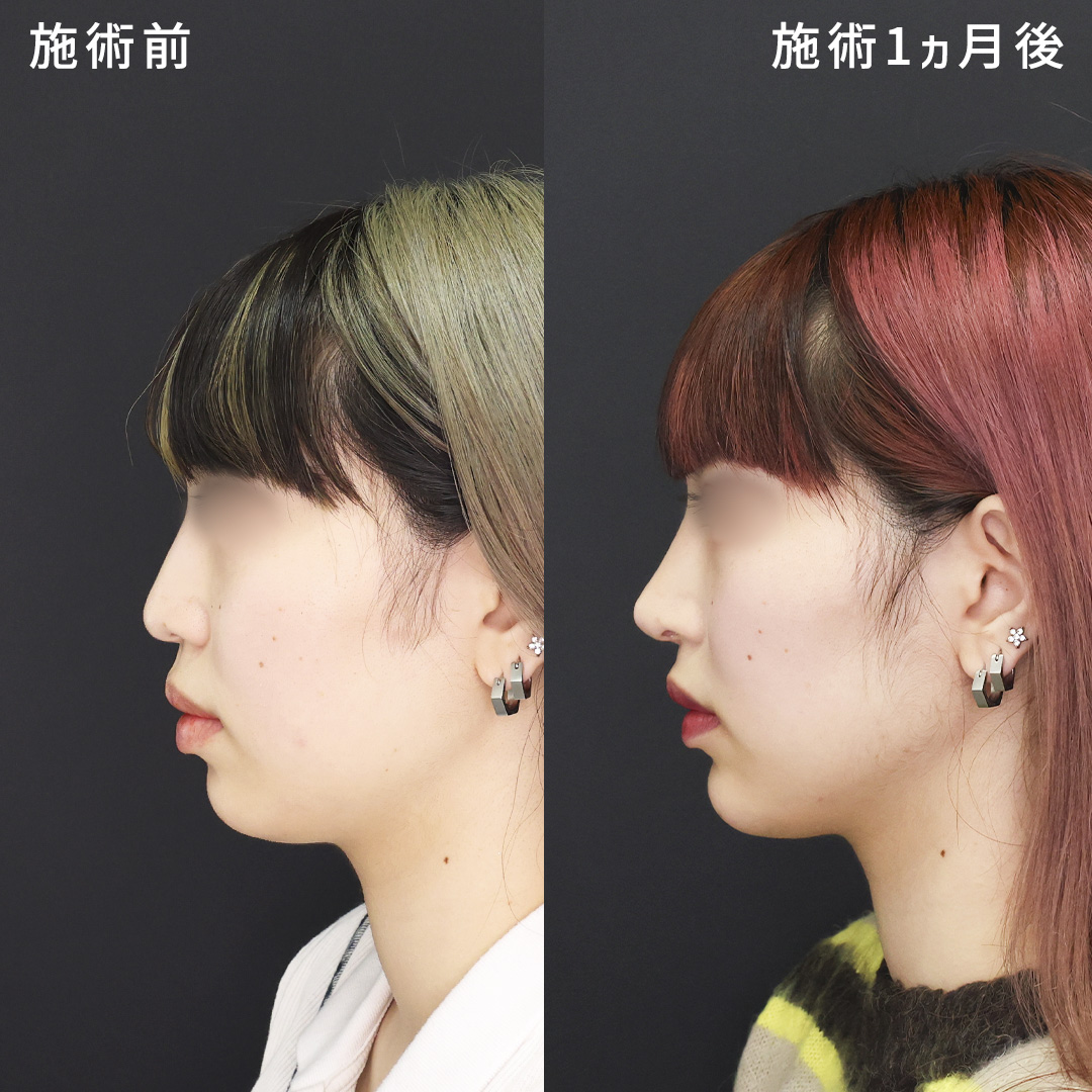 《鼻中隔延長×小顔術》一気に垢抜ける｜Dr.香山のオーダーメイド整形