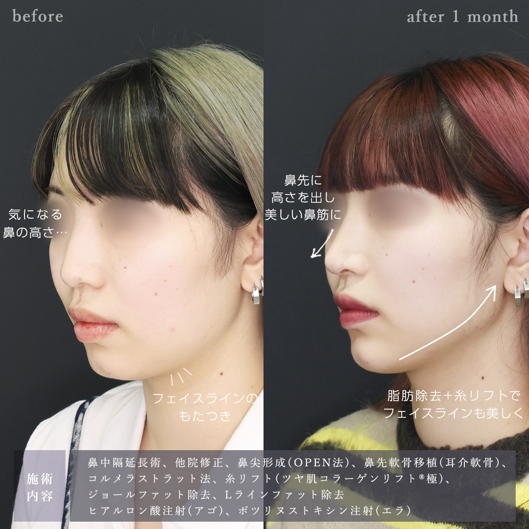 鼻中隔延長術/鼻尖形成・鼻尖縮小/鼻先軟骨移植の症例写真 施術前後 