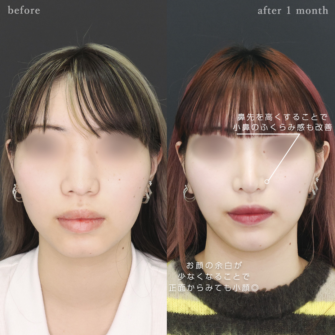鼻中隔延長術/鼻尖形成・鼻尖縮小/鼻先軟骨移植の症例写真 施術前後 