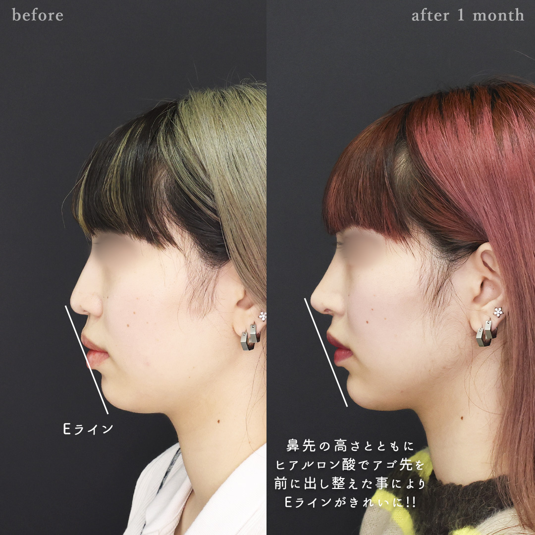 鼻中隔延長術/鼻尖形成・鼻尖縮小/鼻先軟骨移植の症例写真 施術前後 