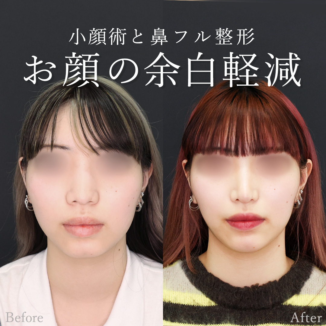 鼻中隔延長術/鼻尖形成・鼻尖縮小/鼻先軟骨移植の症例写真 施術前後 