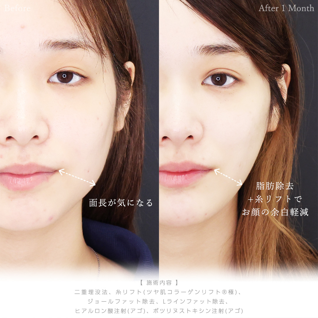 二重埋没法/TAC式 ツヤ肌コラーゲンリフト®/ジョールファット除去の症例写真 施術前後 