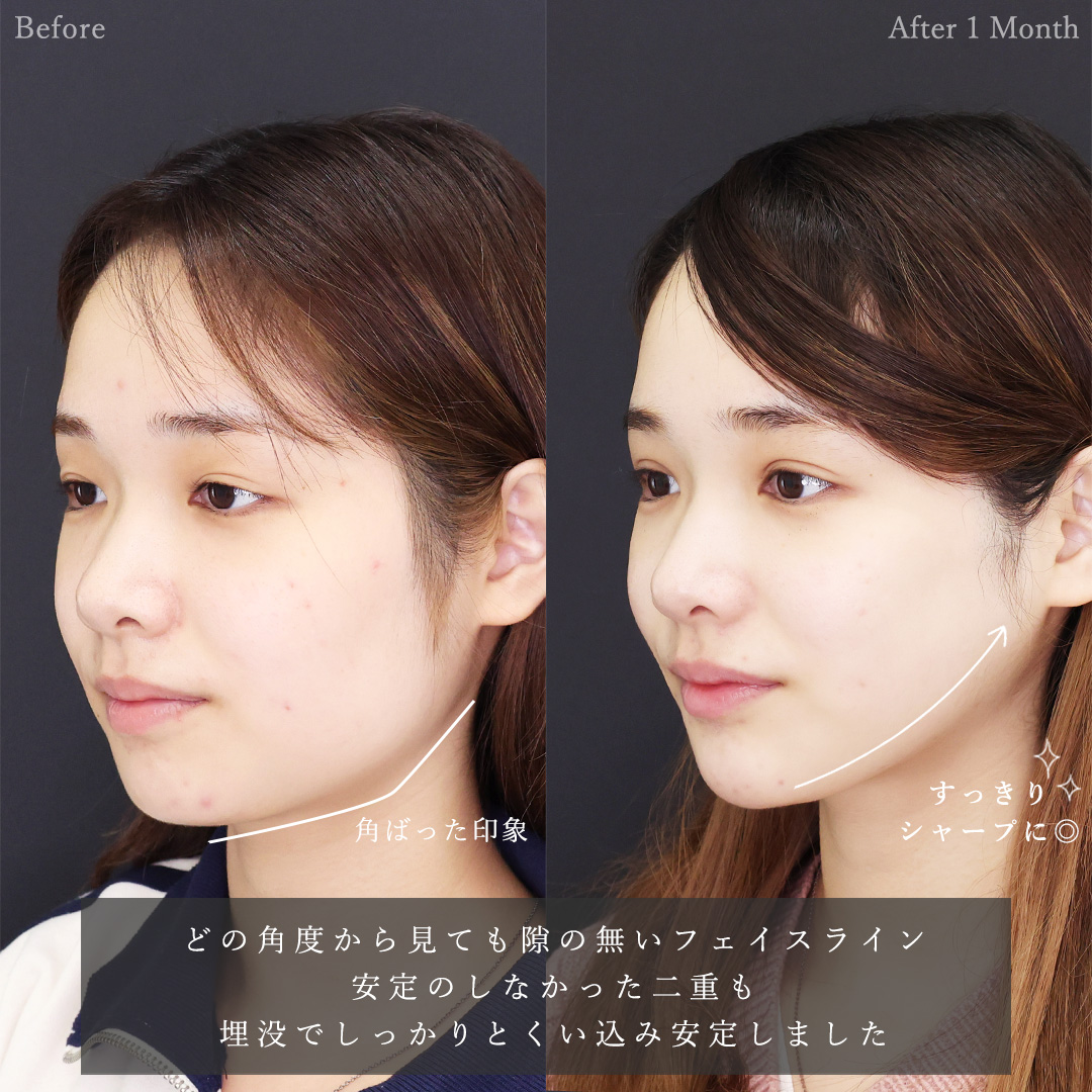 二重埋没法/TAC式 ツヤ肌コラーゲンリフト®/ジョールファット除去の症例写真 施術前後 