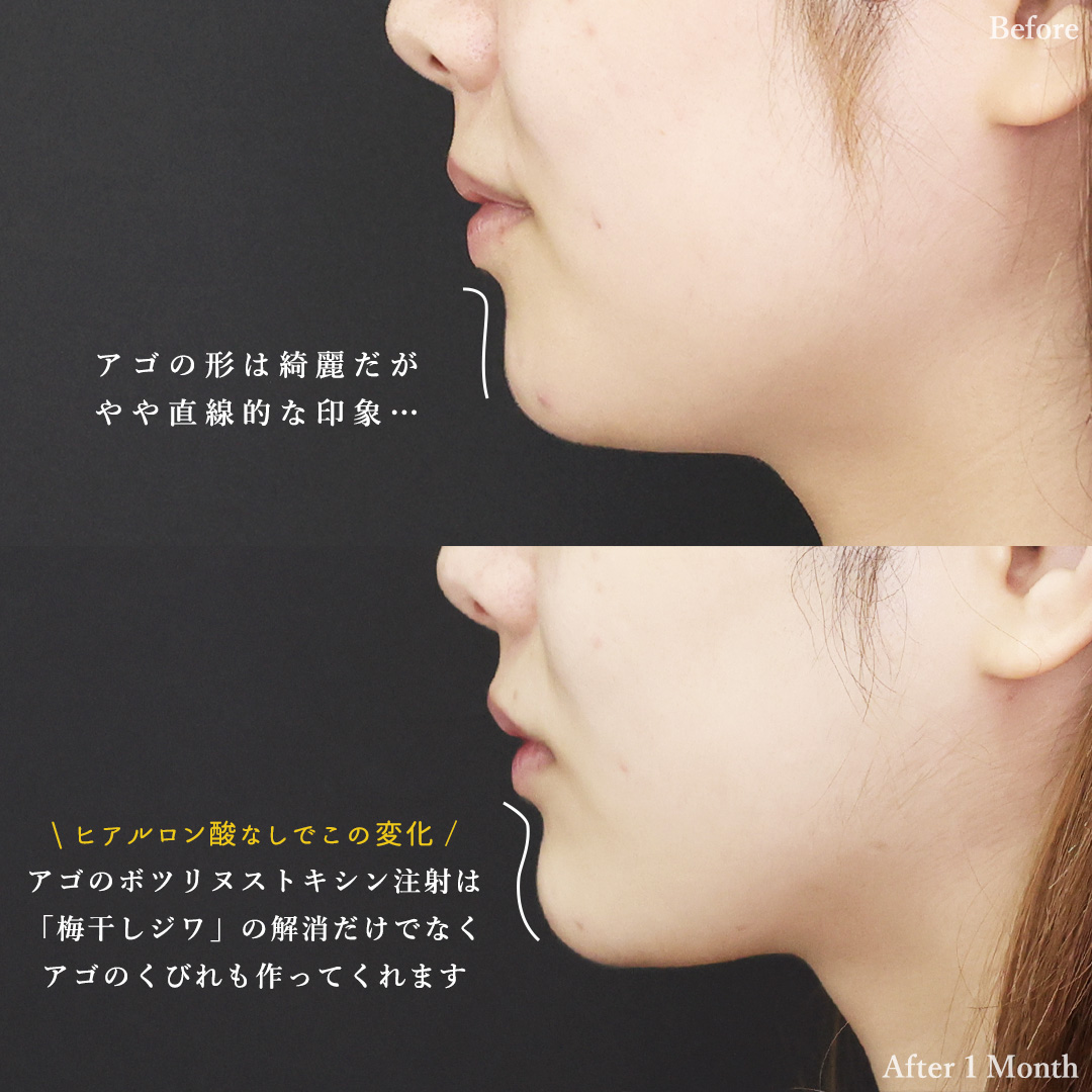 二重埋没法/TAC式 ツヤ肌コラーゲンリフト®/ジョールファット除去の症例写真 施術前後 