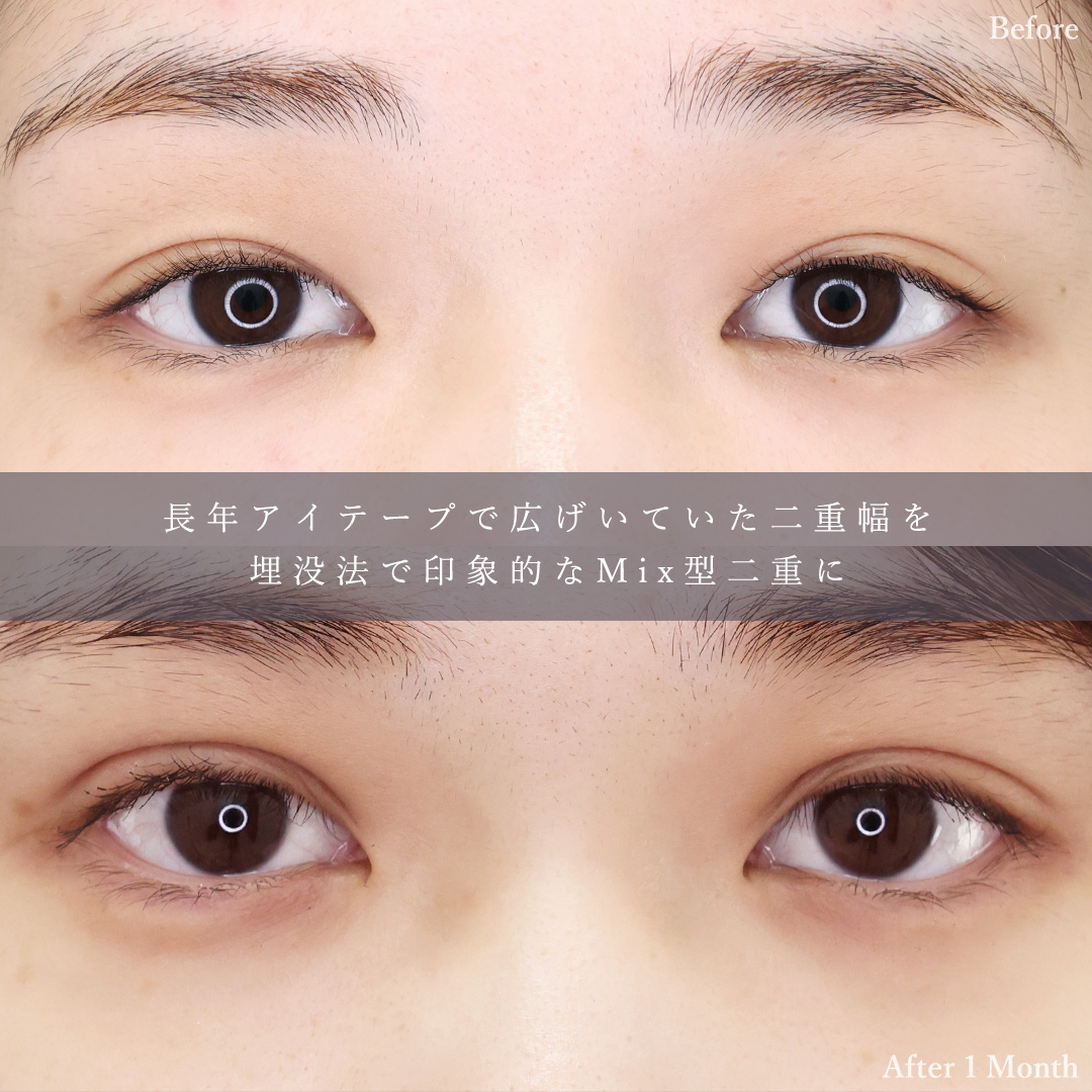 二重埋没法/TAC式 ツヤ肌コラーゲンリフト®/ジョールファット除去の症例写真 施術前後 