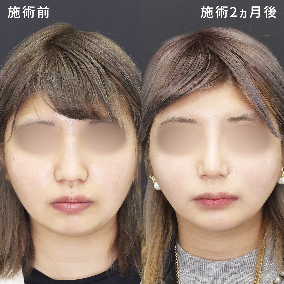 【オーダーメイド鼻整形】形成外科専門医の忘れ鼻形成