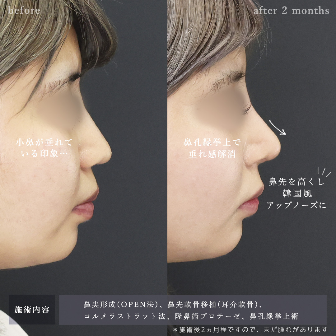 鼻尖形成・鼻尖縮小/鼻先軟骨移植/隆鼻術（プロテーゼ・自家組織）の症例写真 施術前後 