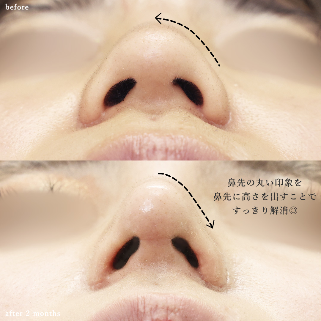 鼻尖形成・鼻尖縮小/鼻先軟骨移植/隆鼻術（プロテーゼ・自家組織）の症例写真 施術前後 