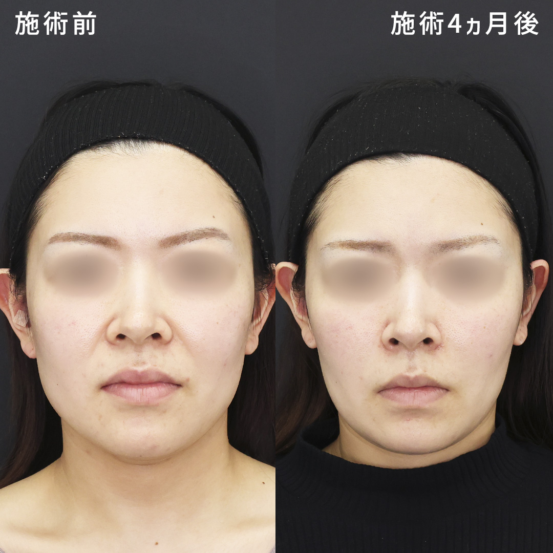 ほうれい線剥離×鼻整形で叶える【20代：老け見え解消】