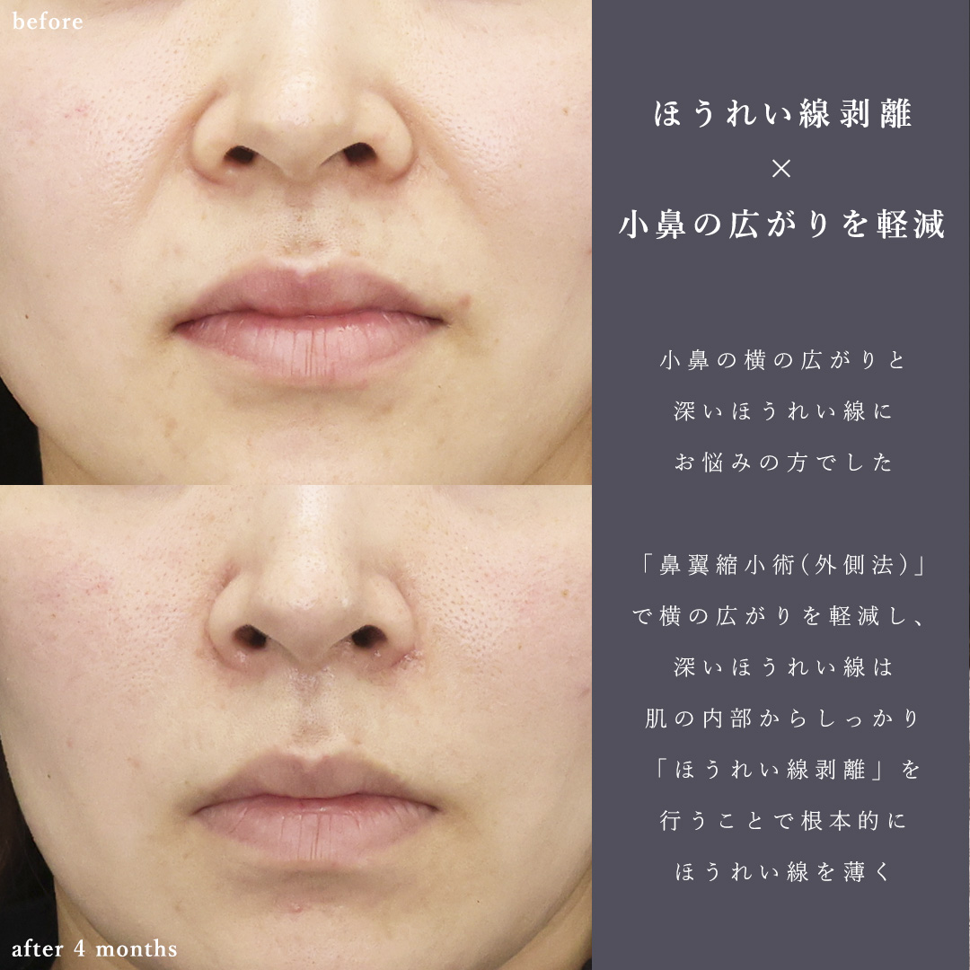 TAC式 鼻翼縮小術（小鼻縮小）/口整形：その他（ほうれい線剥離など）/ほうれい線のヒアルロン酸注射の症例写真 施術前後 