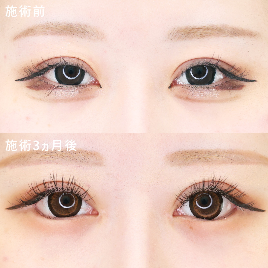 形成外科専門医の目元フル整形｜眉下切開術×タレ目形成×目頭切開術