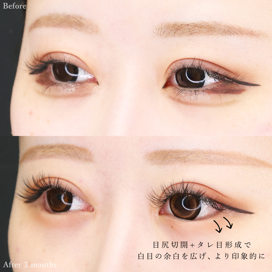 眉毛下切開術/目頭切開術/目尻切開術の症例写真 施術前後 