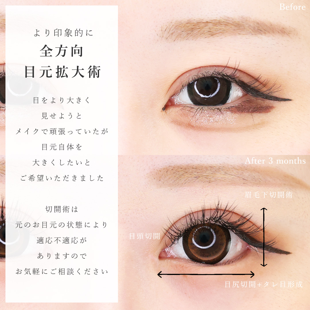 眉毛下切開術/目頭切開術/目尻切開術の症例写真 施術前後 