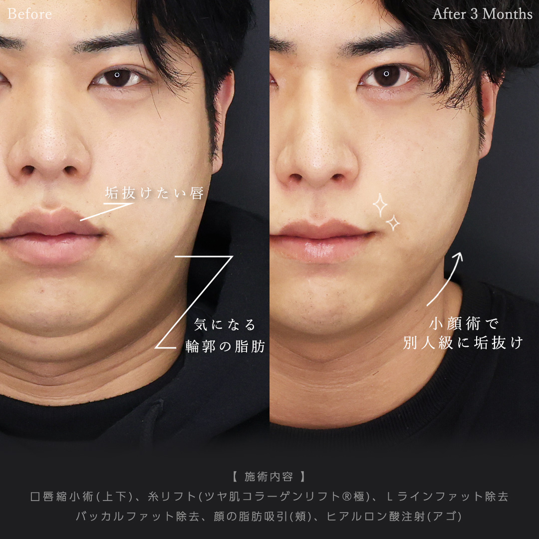 口唇縮小術/TAC式 ツヤ肌コラーゲンリフト®/Lラインファット除去（エラ下脂肪除去）の症例写真 施術前後 