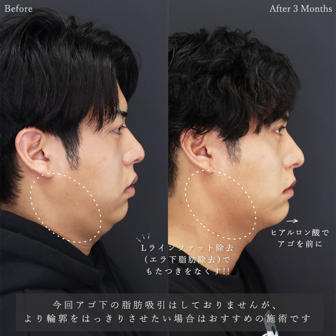 口唇縮小術/TAC式 ツヤ肌コラーゲンリフト®/Lラインファット除去（エラ下脂肪除去）の症例写真 施術前後 