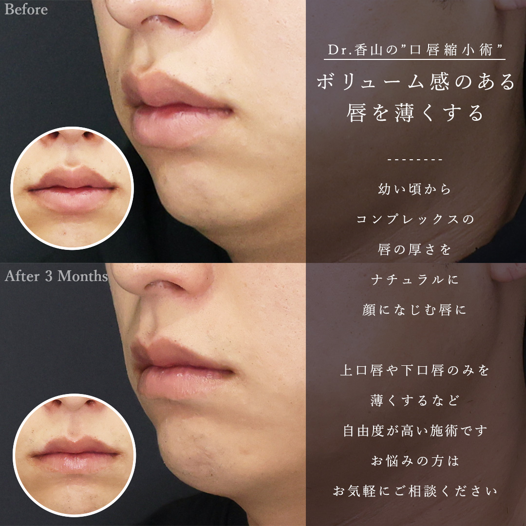 口唇縮小術/TAC式 ツヤ肌コラーゲンリフト®/Lラインファット除去（エラ下脂肪除去）の症例写真 施術前後 