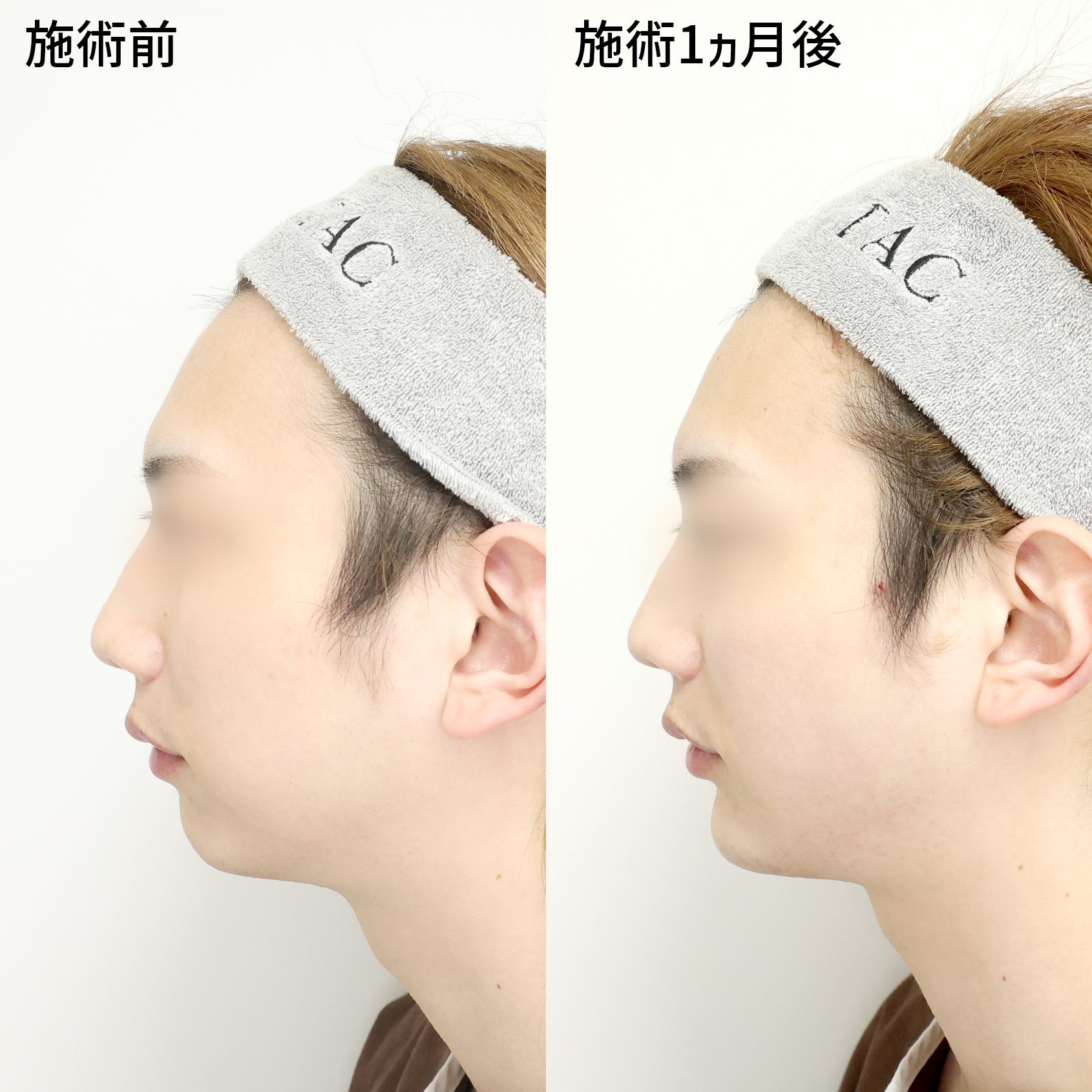 「顎のヒアルロン酸注入」でどの角度から見てもイケメンに！