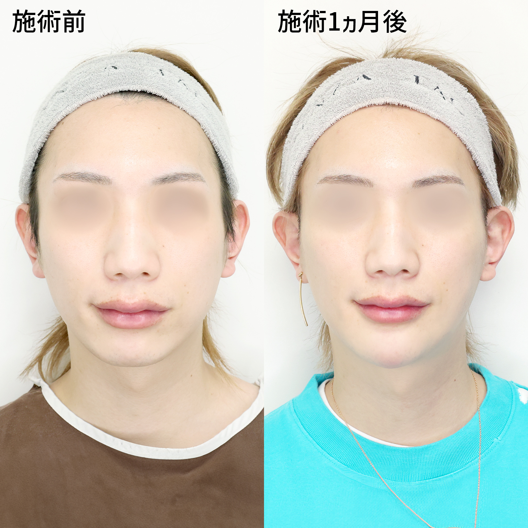 TAC式 ツヤ肌コラーゲンリフト®/エラボトックス注射/顎のヒアルロン酸注射の症例写真 施術前後 