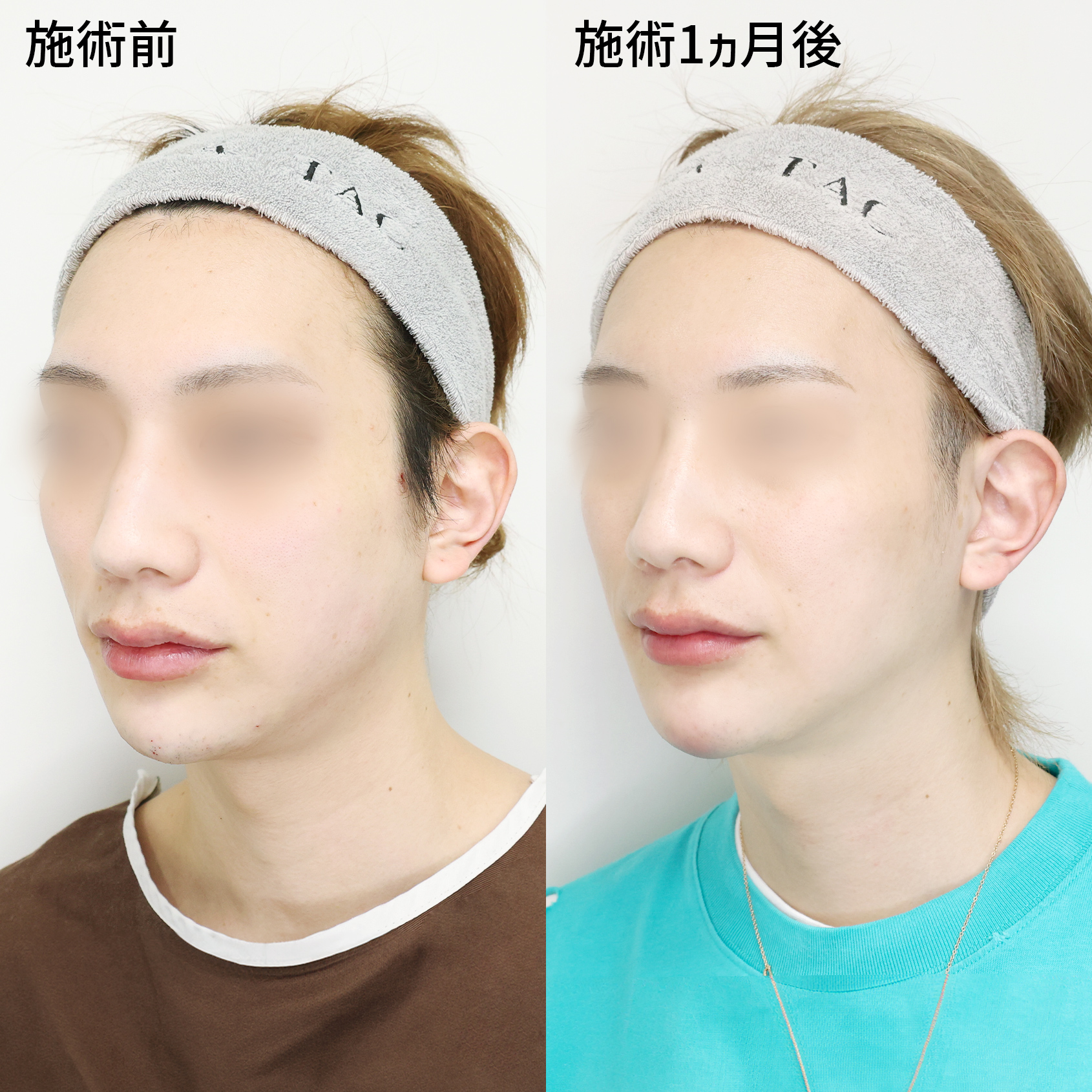 TAC式 ツヤ肌コラーゲンリフト®/エラボトックス注射/顎のヒアルロン酸注射の症例写真 施術前後 