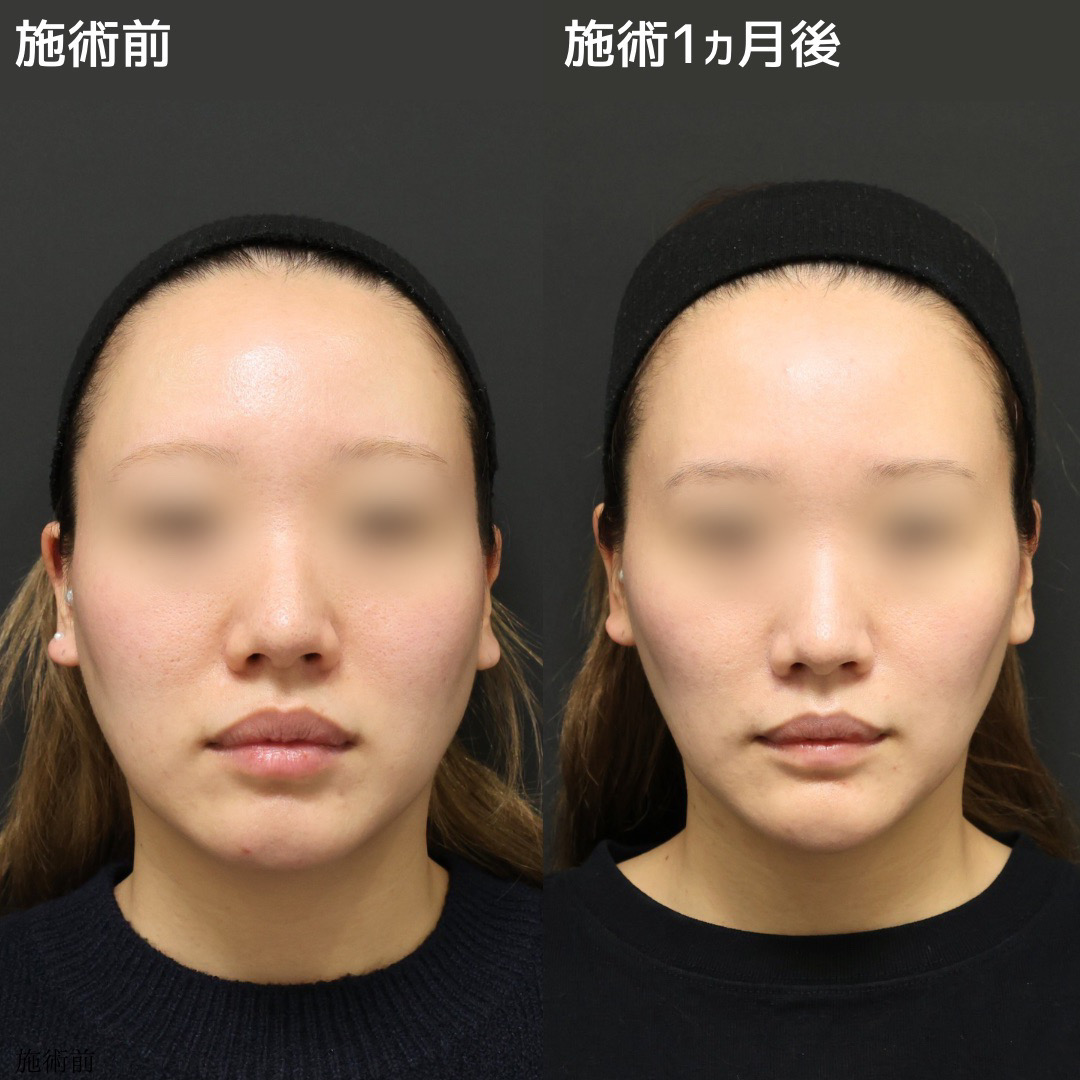 《脂肪吸引なし》でここまで変わる小顔術
