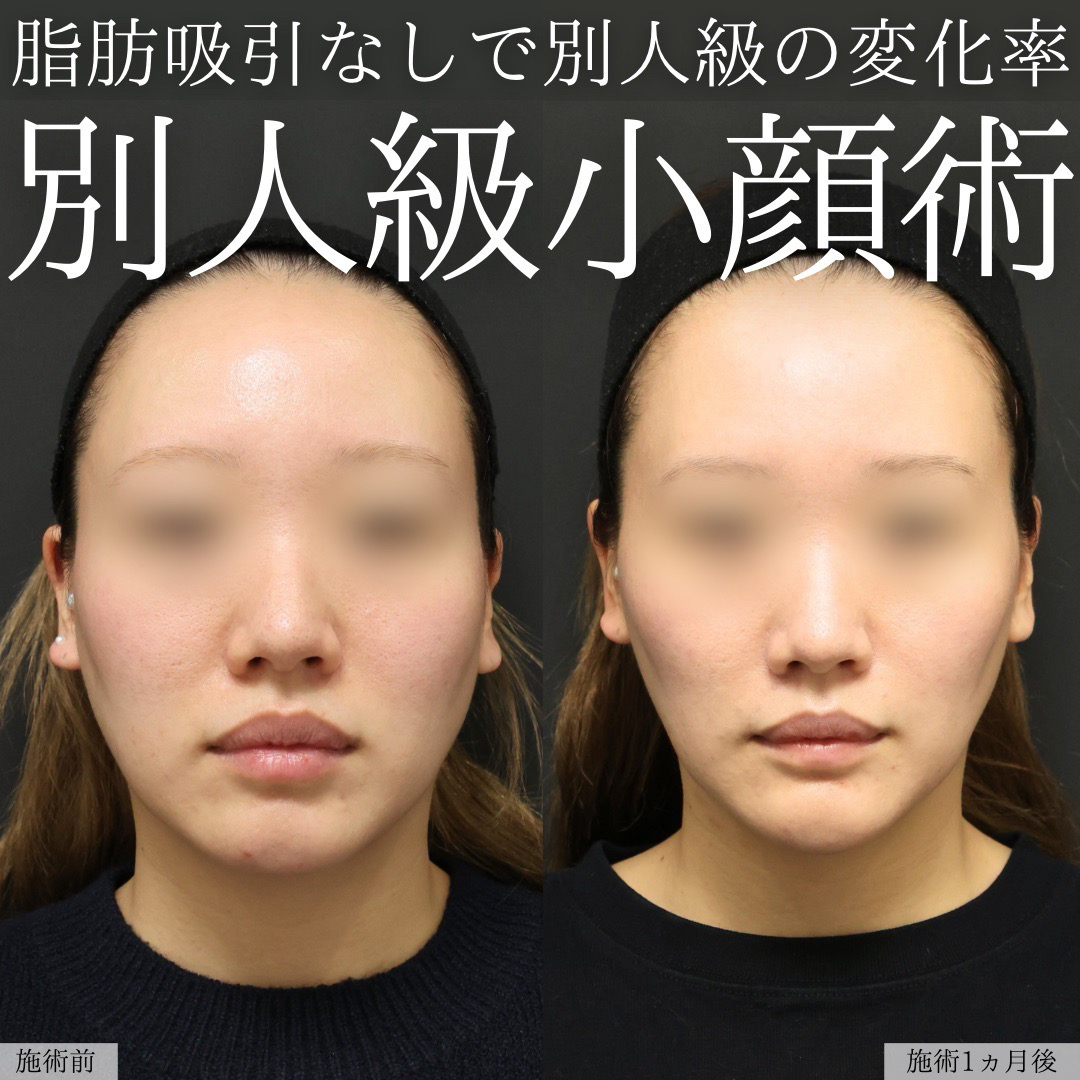 TAC式 ツヤ肌コラーゲンリフト®/ほうれい線のヒアルロン酸注射/顎のヒアルロン酸注射の症例写真 施術前後 