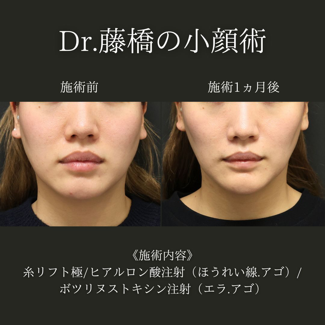 TAC式 ツヤ肌コラーゲンリフト®/ほうれい線のヒアルロン酸注射/顎のヒアルロン酸注射の症例写真 施術前後 