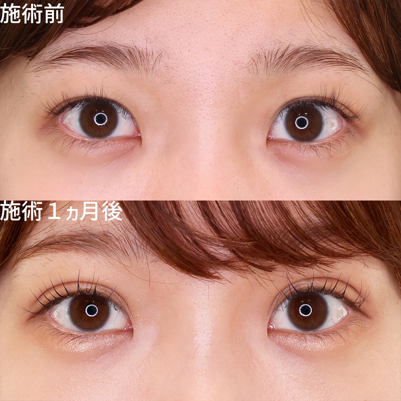 全国から指名多数♡Dr.もりもりの可愛さ爆上がり二重術