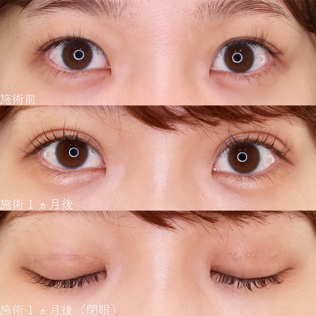 二重埋没法の症例写真 施術前後 