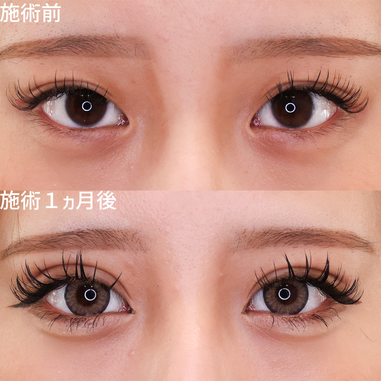 激カワ♡二重整形 -クッキリ平行二重でデカ目効果-