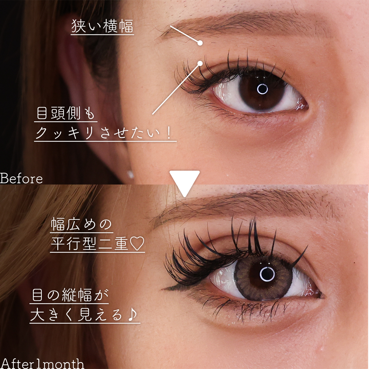 二重埋没法の症例写真 施術前後 