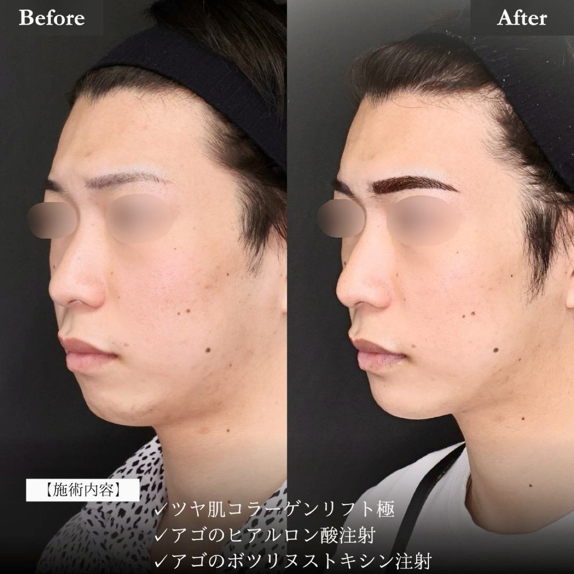 TAC式 ツヤ肌コラーゲンリフト®/顎のヒアルロン酸注射/ボトックス注射：その他の症例写真 施術前後 