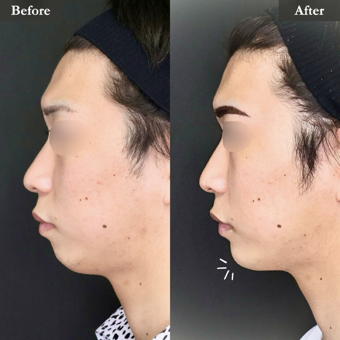TAC式 ツヤ肌コラーゲンリフト®/顎のヒアルロン酸注射/ボトックス注射：その他の症例写真 施術前後 