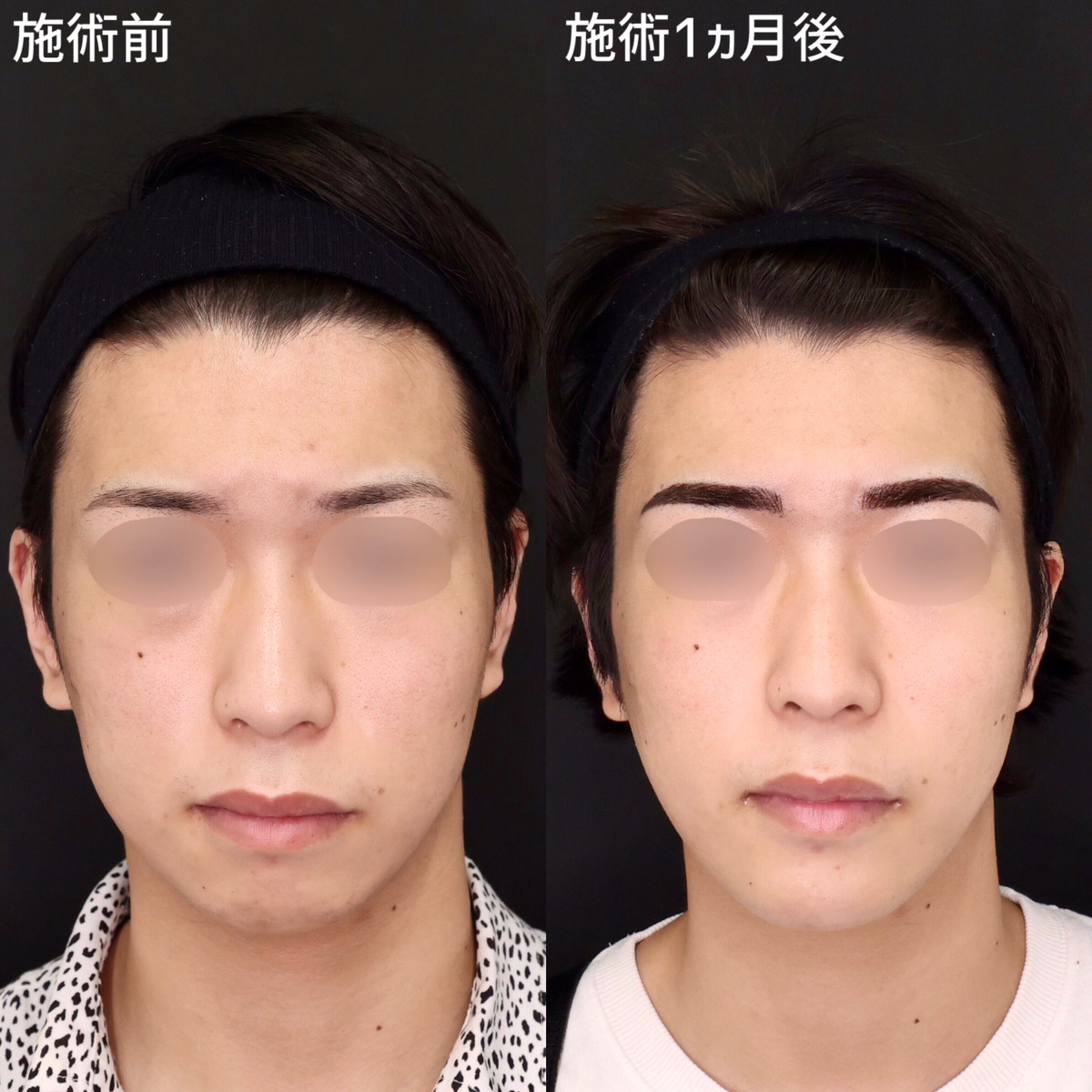 【小顔整形】輪郭を整えてよりイケメンに！