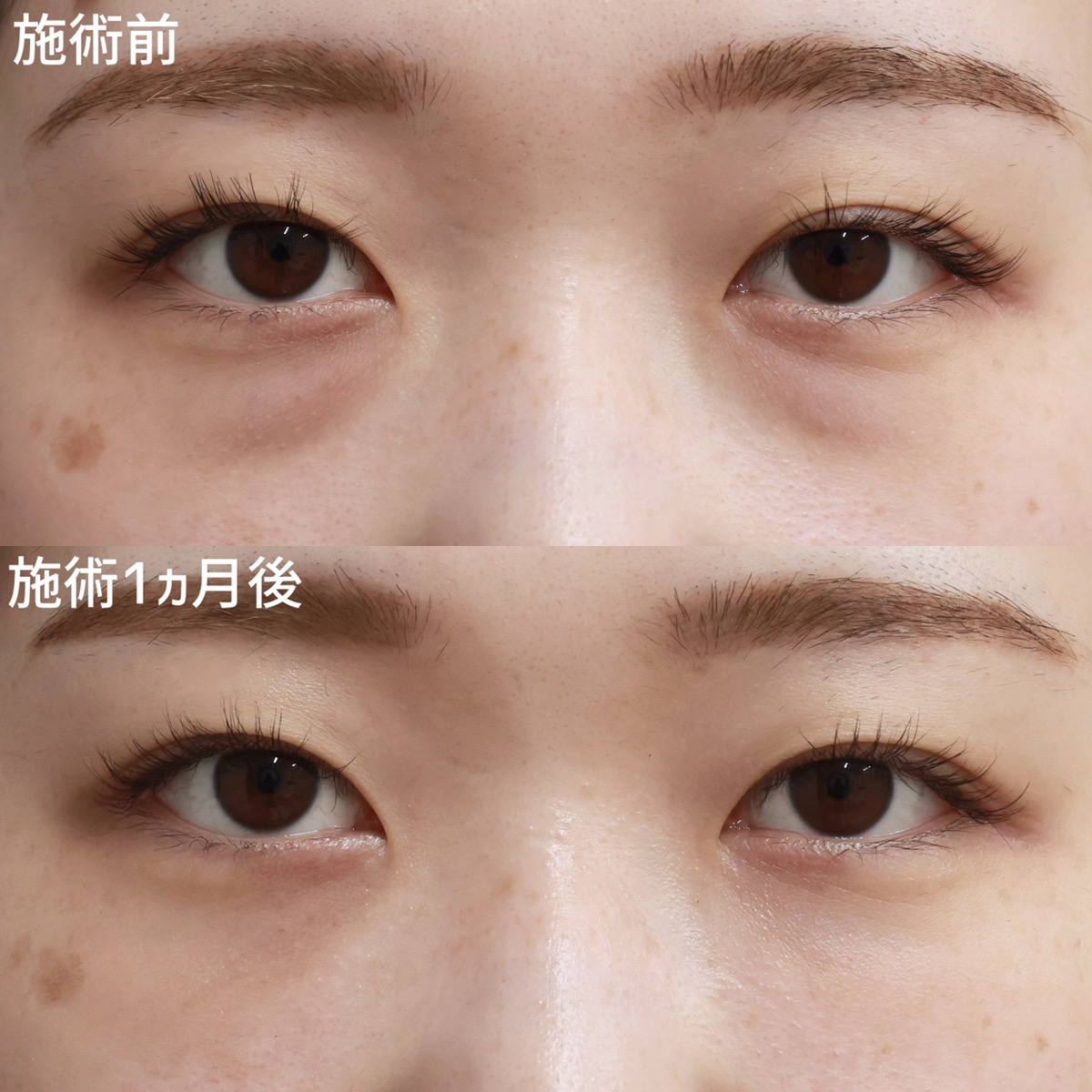 【クマ取り】疲れた印象を解消し、目元に自信を取り戻す！