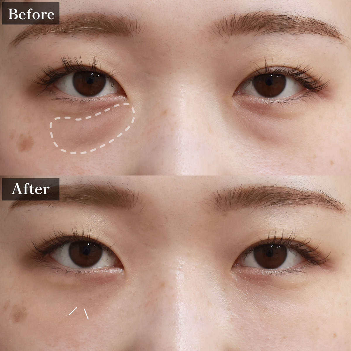 下眼瞼切開術（クマ・たるみとり）/顔の脂肪注入(コンデンスリッチフェイス)の症例写真 施術前後 