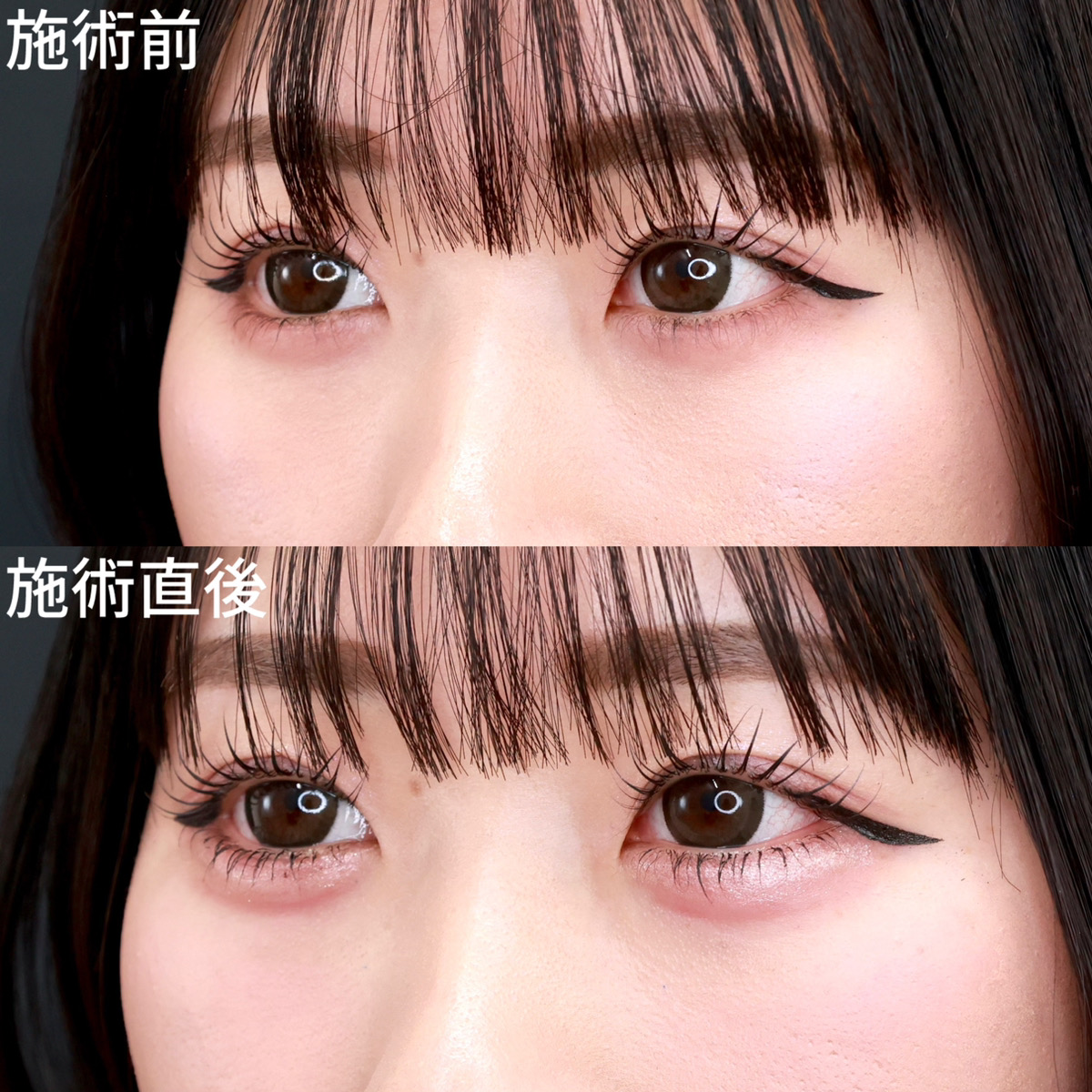 涙袋形成（ヒアルロン酸注射）の症例写真 施術前後 