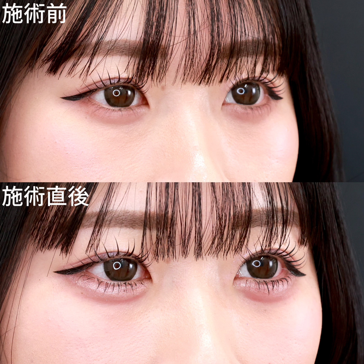 涙袋形成（ヒアルロン酸注射）の症例写真 施術前後 