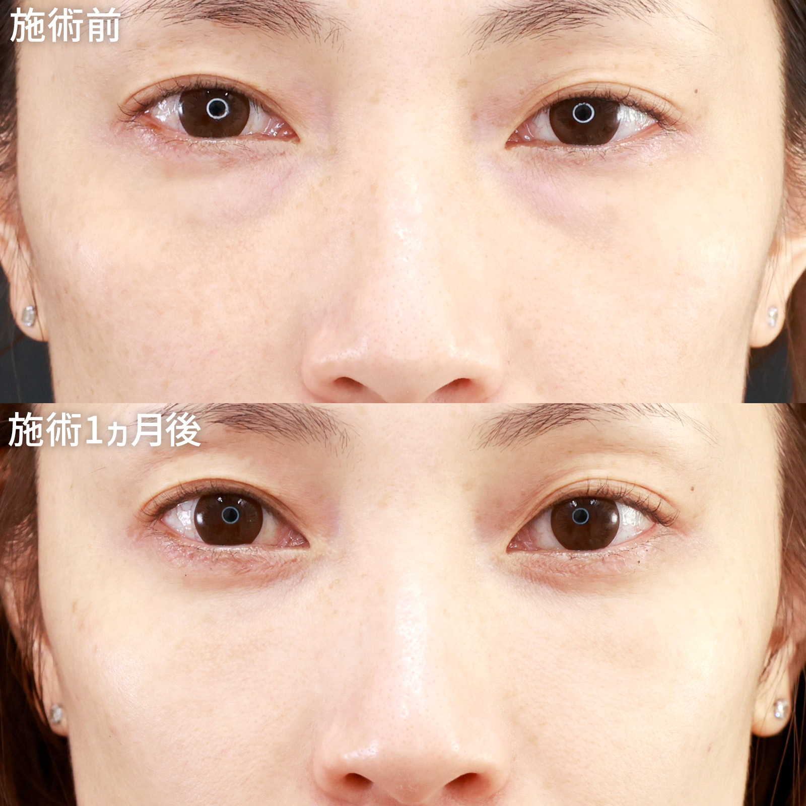 【目の下のクマ取り】見た目年齢を左右する黒クマを、美容医療でスッキリ解消！