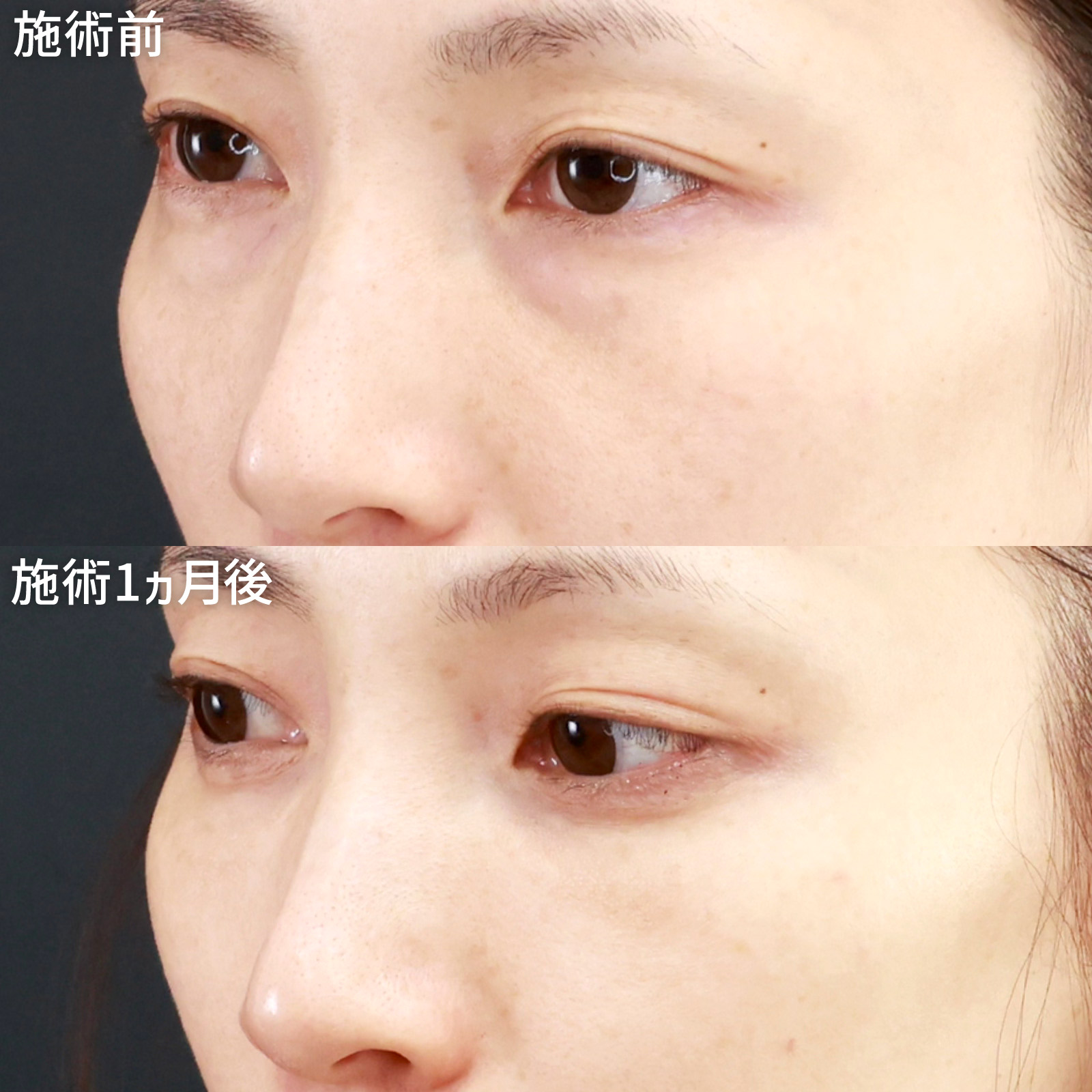 下眼瞼脱脂術（目の下のたるみ取り・目の下の脂肪ふくらみ取り）/顔の脂肪注入(コンデンスリッチフェイス)の症例写真 施術前後 