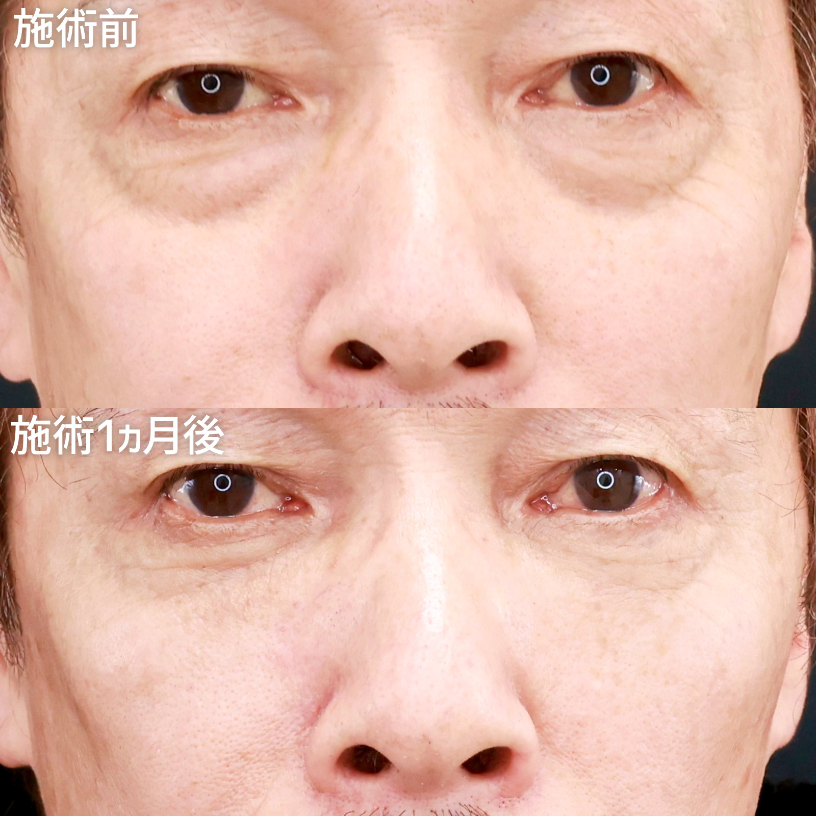 下眼瞼脱脂術(目の下のたるみ取り・目の下の脂肪ふくらみ取り)/顔の脂肪注入(コンデンスリッチフェイス)の症例写真 施術前後