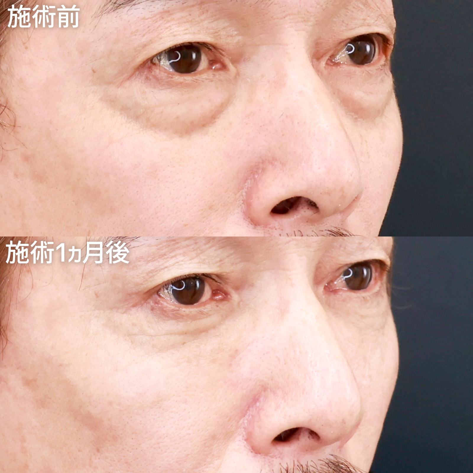 下眼瞼脱脂術(目の下のたるみ取り・目の下の脂肪ふくらみ取り)/顔の脂肪注入(コンデンスリッチフェイス)の症例写真 施術前後