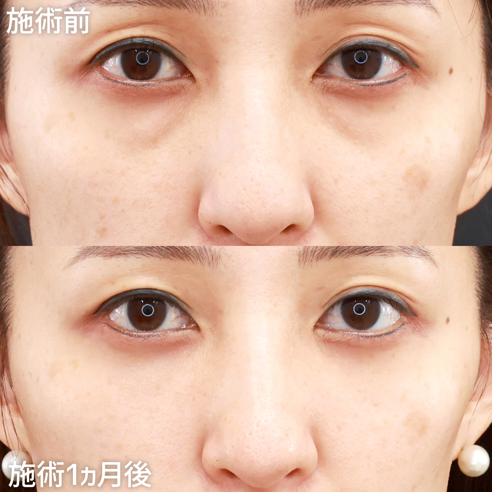 【下眼瞼脱脂＆脂肪注入】眼窩脂肪が原因である目の下の黒クマ・影クマを改善！
