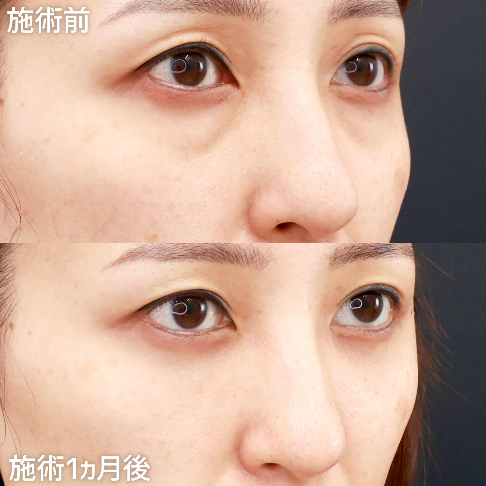 下眼瞼脱脂術（目の下のたるみ取り・目の下の脂肪ふくらみ取り）/顔の脂肪注入(コンデンスリッチフェイス)の症例写真 施術前後 