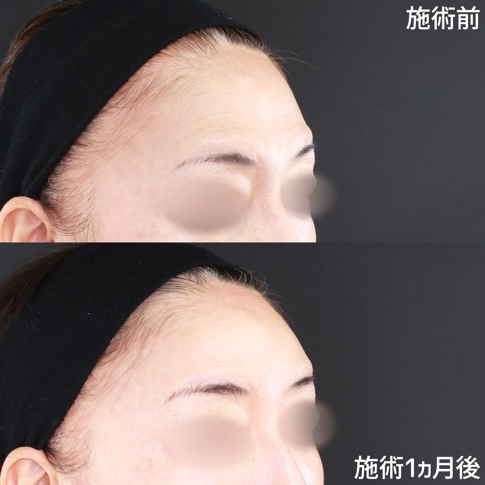 【おでこヒアルロン酸】ゴツゴツした印象を改善！女性らしさに磨きがかかる“丸いおでこ”