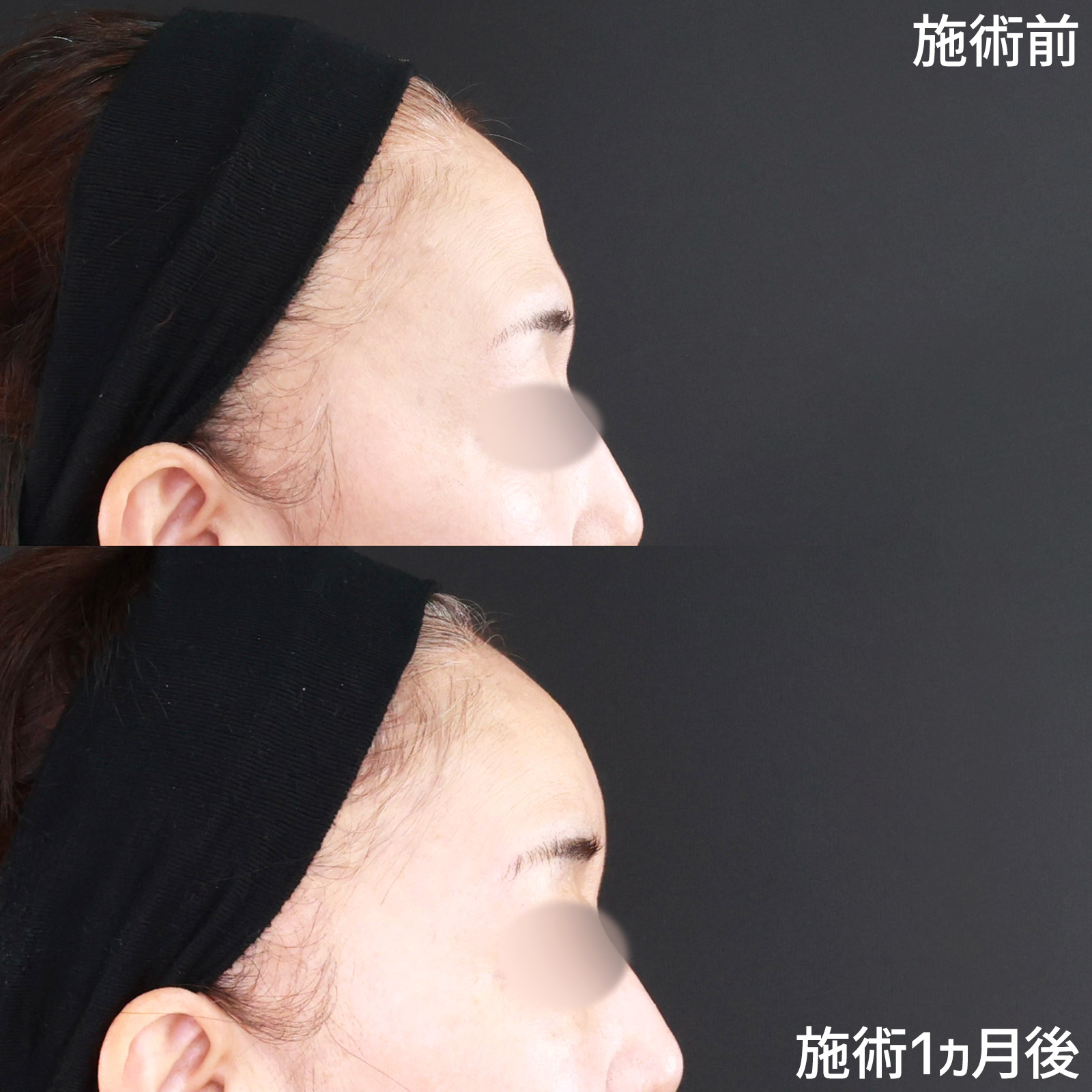 おでこ・こめかみのヒアルロン酸注射の症例写真 施術前後 