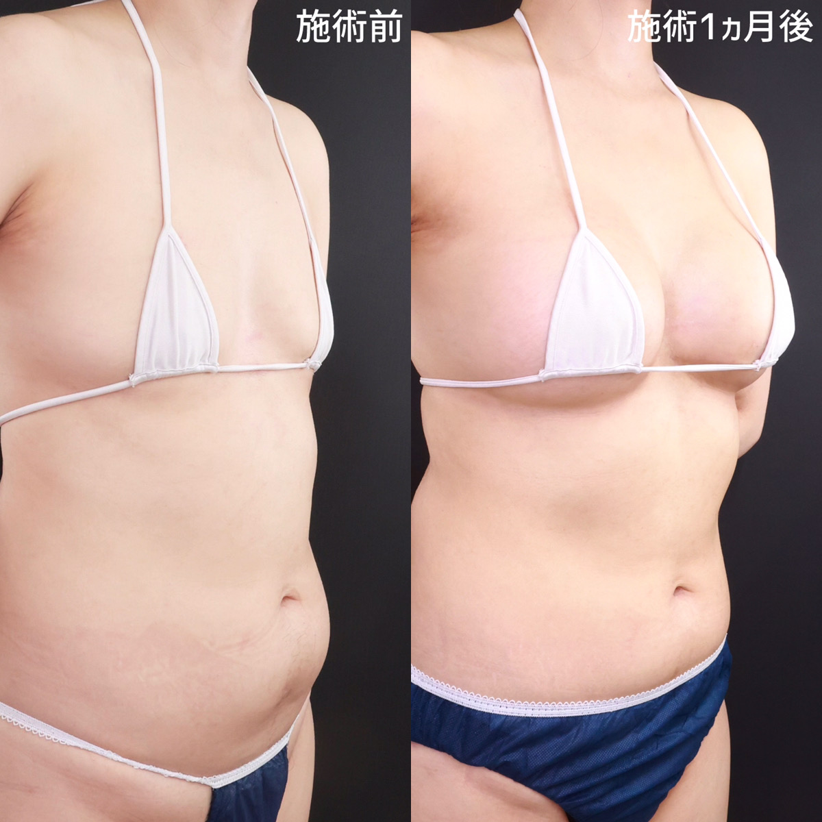 シリコンバッグ豊胸（人工乳腺バッグ）の症例写真 施術前後 