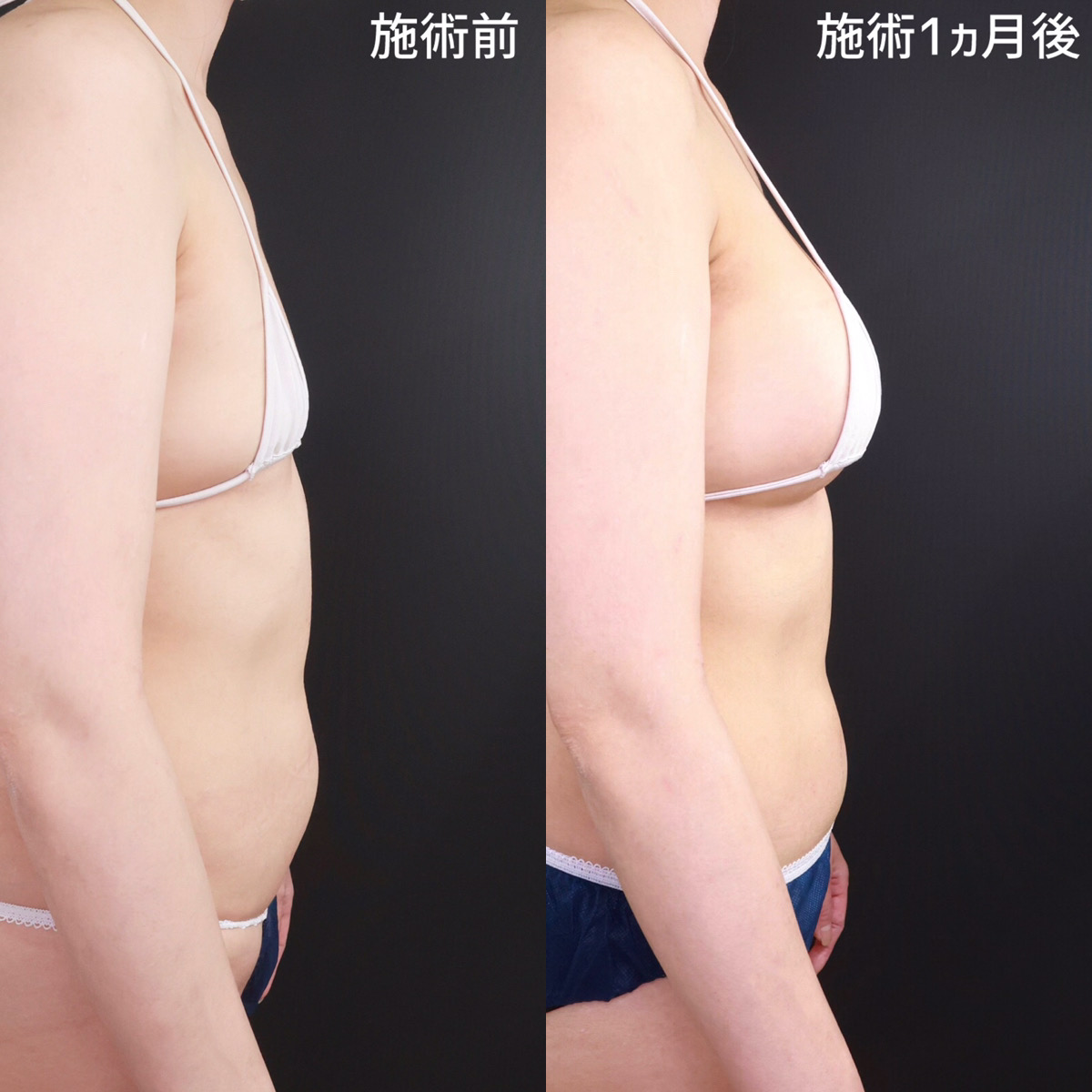 シリコンバッグ豊胸（人工乳腺バッグ）の症例写真 施術前後 