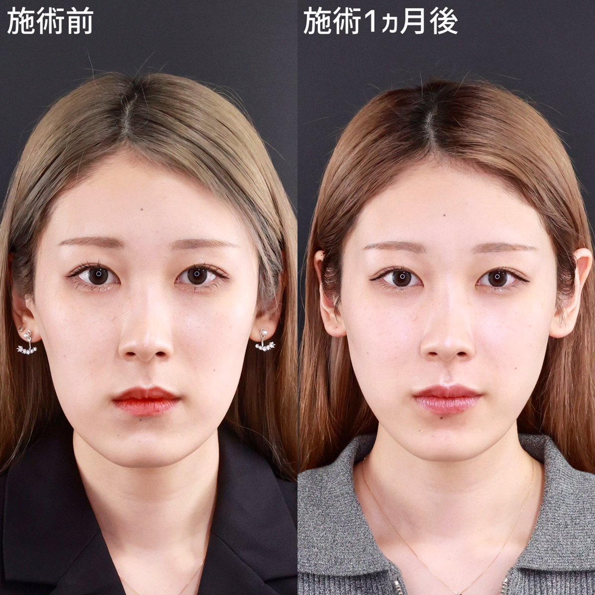 【小顔整形】脱老け顔！整形感のないナチュラルな仕上がり